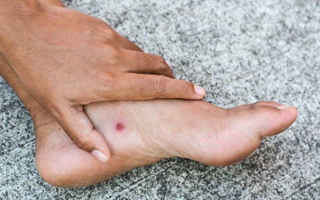 Waspada Kaki Diabetes, 18,6 Juta Orang Terkena Setiap Tahun