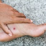Waspada Kaki Diabetes, 18,6 Juta Orang Terkena Setiap Tahun