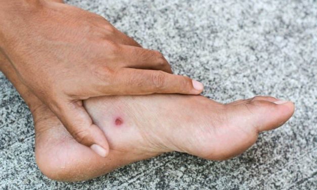 Waspada Kaki Diabetes, 18,6 Juta Orang Terkena Setiap Tahun