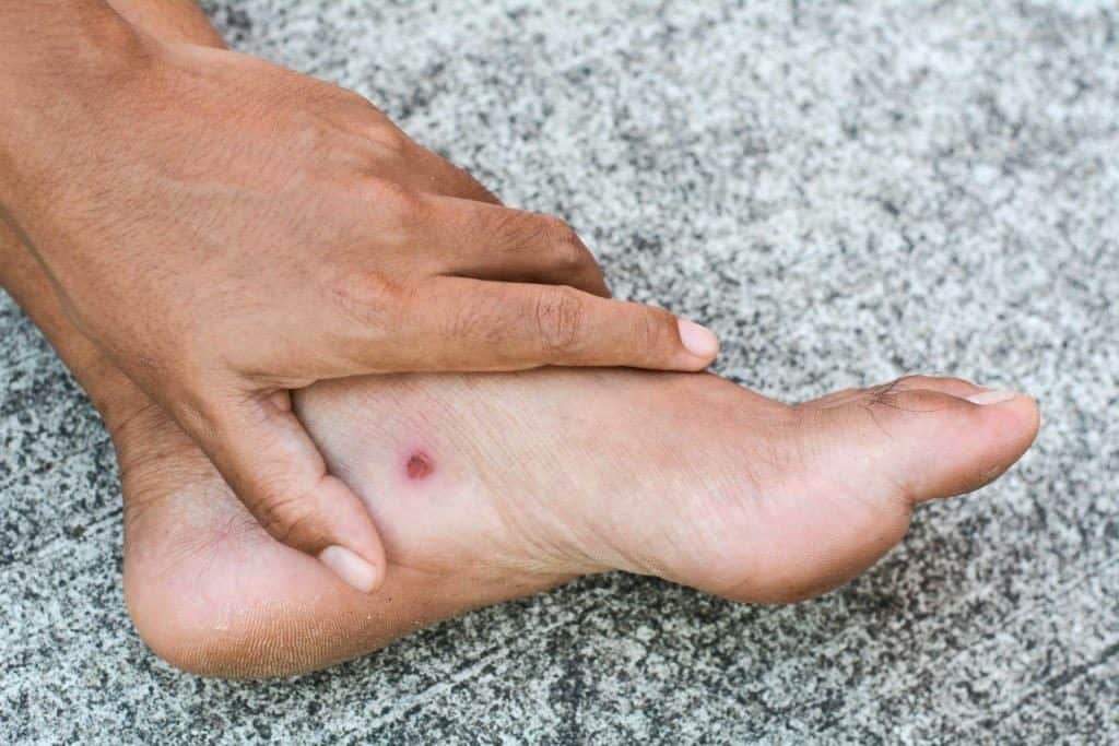 Waspada Kaki Diabetes